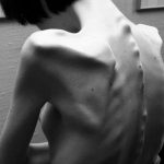  anorex-bulimia.com lechenie simptom